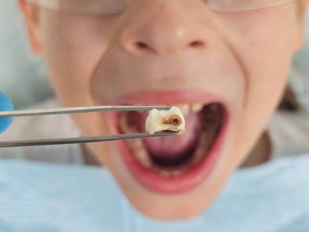 Best Teeth Whitening  in Fourche Crossing, LA